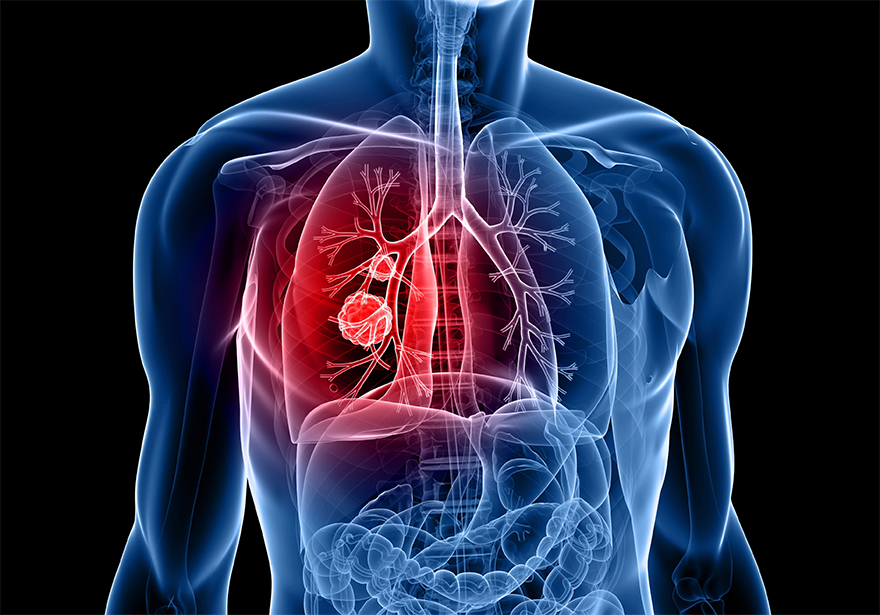 Patient Testimonial: Cannabis Killed My Stage IV Lung Cancer